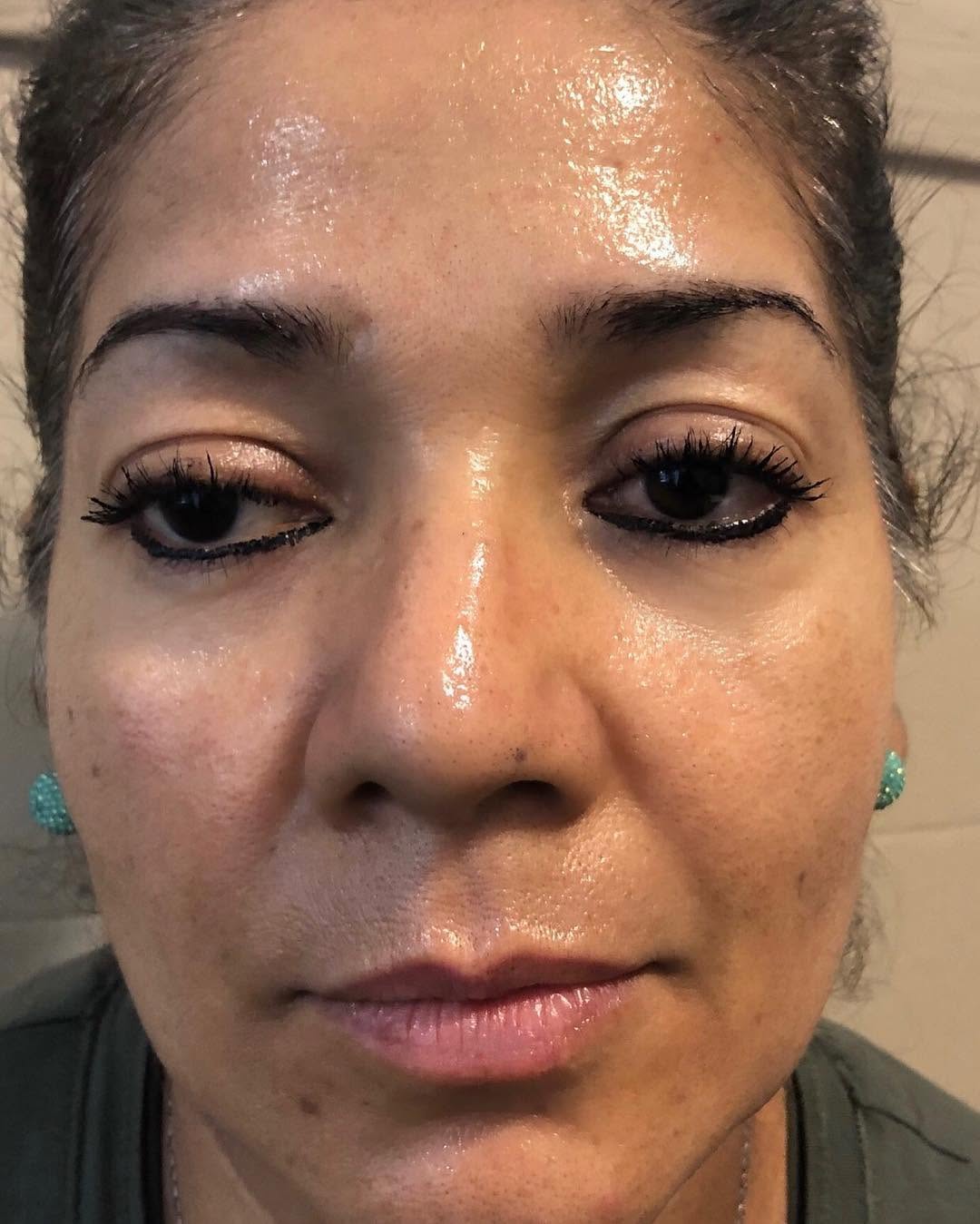 Skin four weeks after a first healed microneedling session