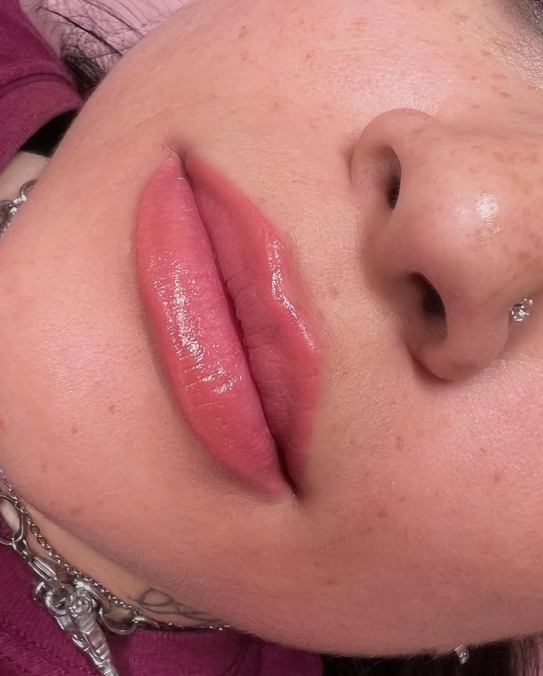 Lip neutralizing treatment result